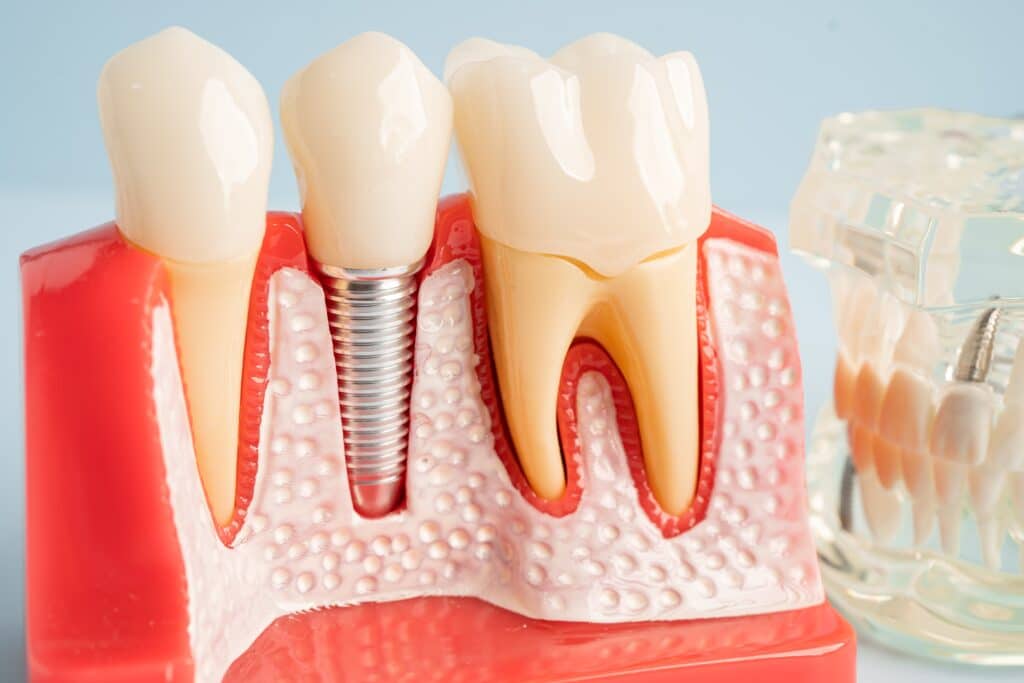 Dental Implants Nashville